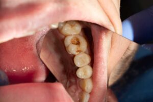 cavity molar