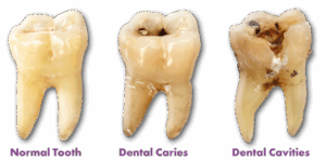 Tooth Cavity Symptoms: What to Know and When to Act - Surfside Smiles