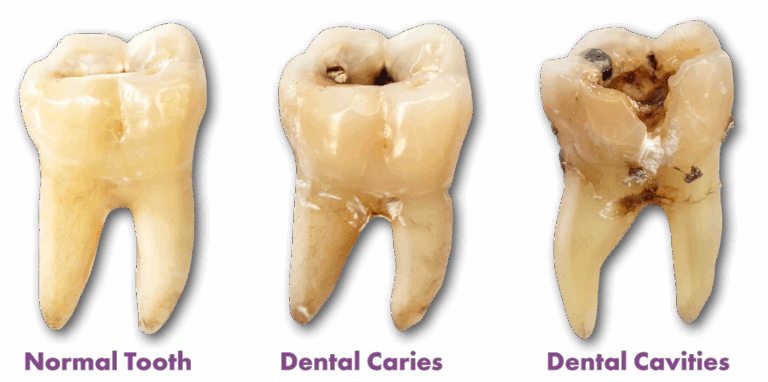 Side-by-side image showing a healthy molar, a molar with visible dental caries in the center, and a severely decayed tooth, emphasizing the progression of tooth cavity stages.