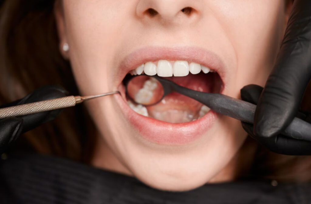 Tooth Cav Tooth Cavity Symptoms: What to Know and When to Act - Surfside Smiles